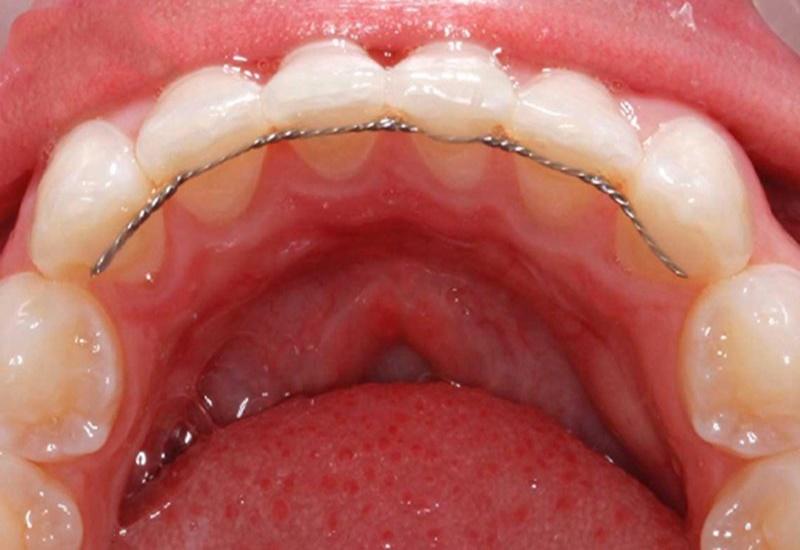 Hàm duy trì cố định giúp bệnh nhân đeo hàm liên tục