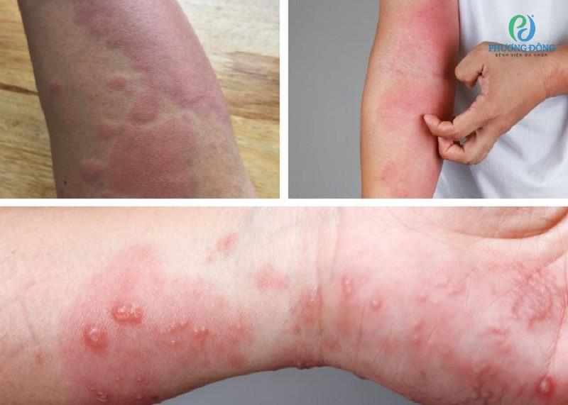 Dị ứng thời tiết có thể xảy ra ở mọi đối tượng