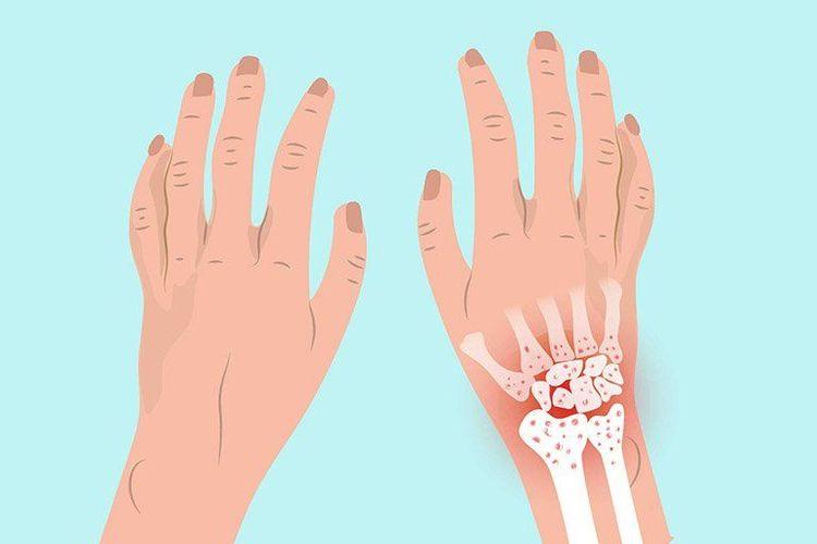 Khớp cổ tay và một số ổ khớp thường gặp tình trạng lắng đọng canxi ở khớp