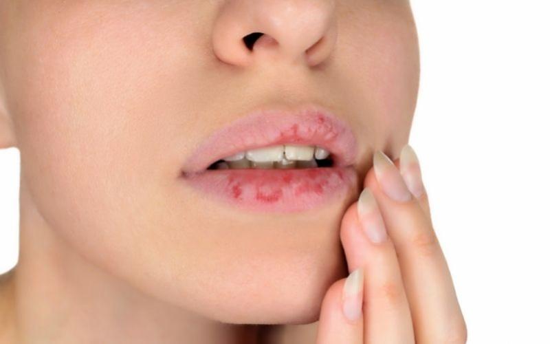 Chàm môi làm người bệnh ngứa rát, khó chịu
