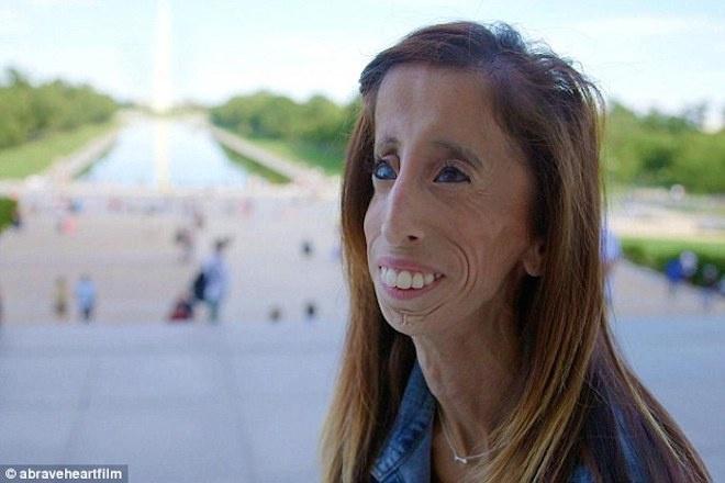 Lizzie Velasquez - „cô gái xấu xí nhất thế giới“. Nguôn Dailymail