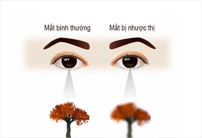 Tìm hiểu về bệnh nhược thị - Bệnh viện Bãi Cháy