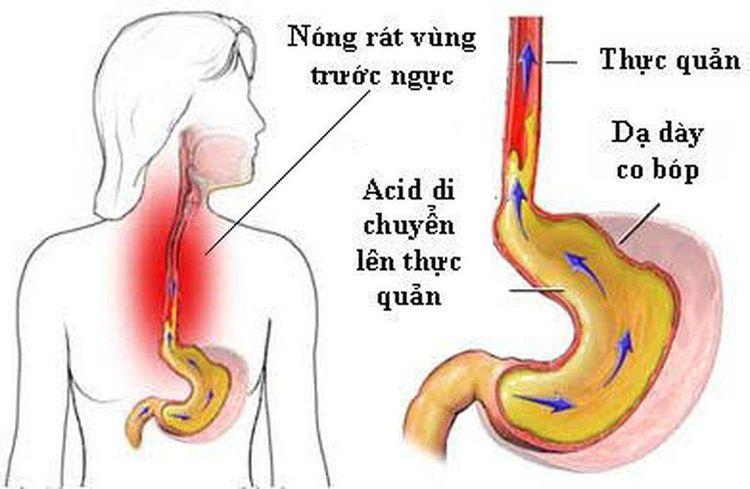 Quá trình trào ngược họng - thanh quản