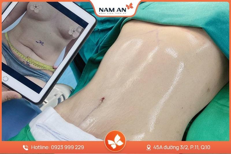 hình ảnh trước và sau khi tạo hình thành bụng