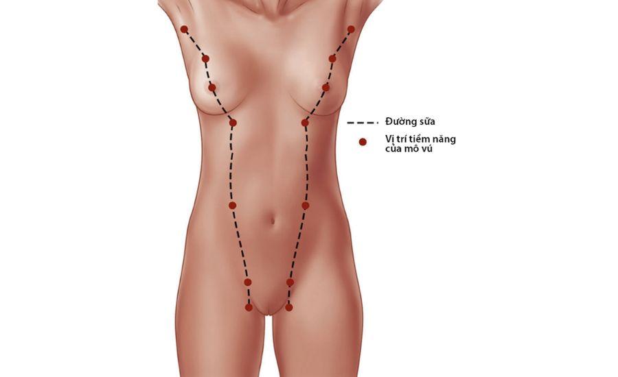 Những vị trí trên cơ thể có thể xuất hiện tuyến vú phụ