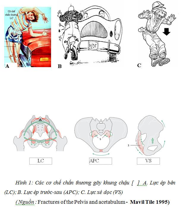 Gãy xương chậu