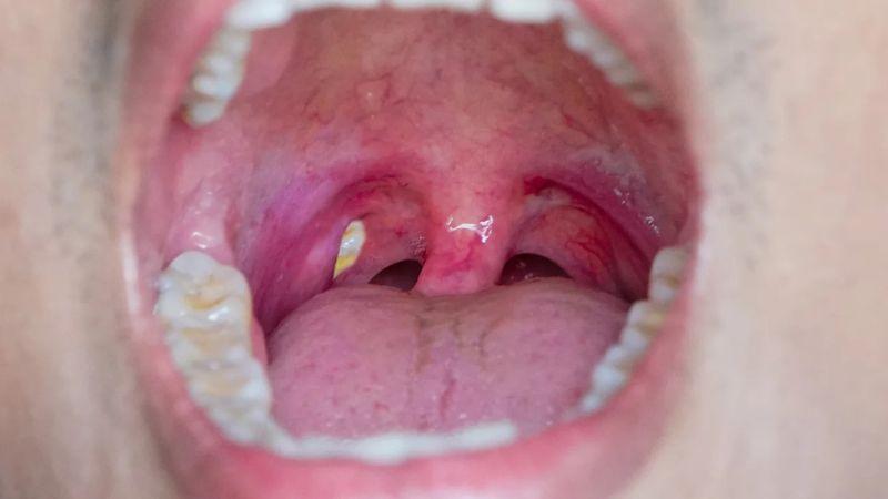 Hạt trắng trong họng báo hiệu nhiều vấn đề sức khoẻ khác nhau