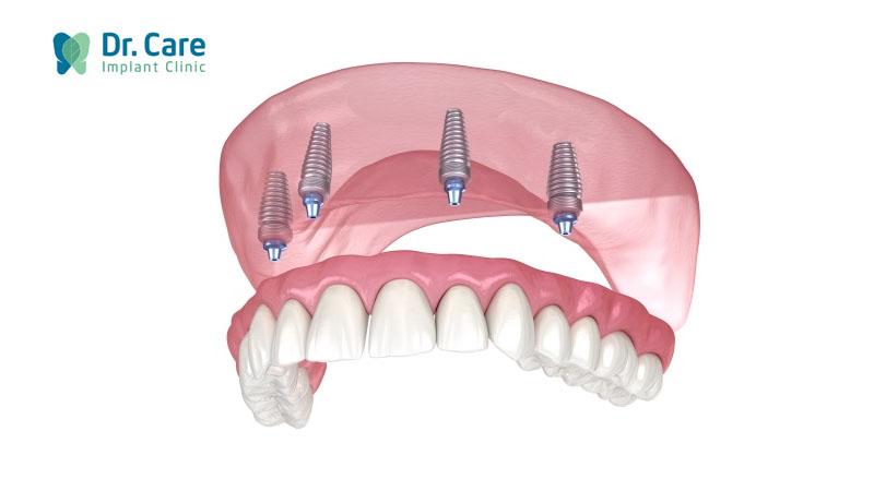 Phục hồi răng toàn hàm trên Implant là gì? 