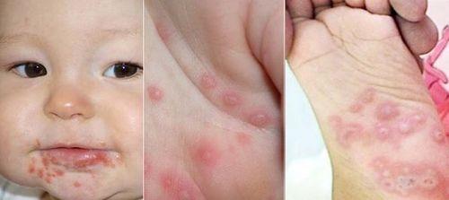 Hình ảnh bệnh tay chân miệng theo từng giai đoạn