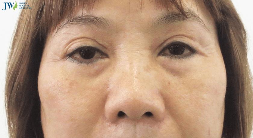 Mắt buồn là gì