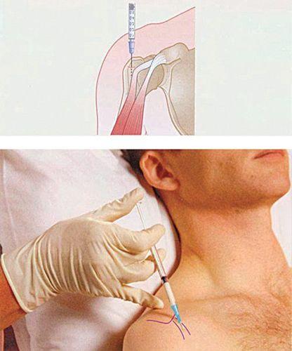 Người rách chỏm xoay khớp vai có thể được điều trị bằng cách tiêm corticoid.