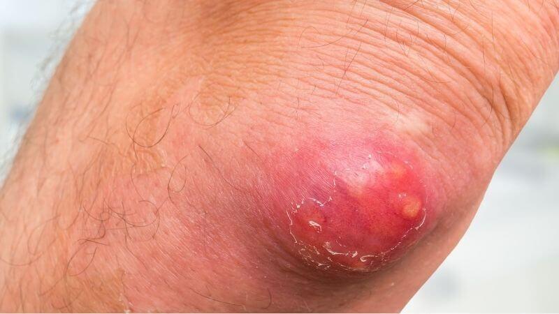 Bệnh hậu bối gồm nhiều nhọt liên kết với nhau