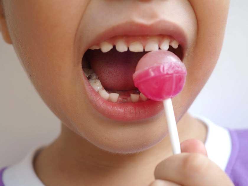 Thích ăn đồ ngọt nhưng không chăm sóc răng đúng cách khiến trẻ dễ bị xiết ăn răng