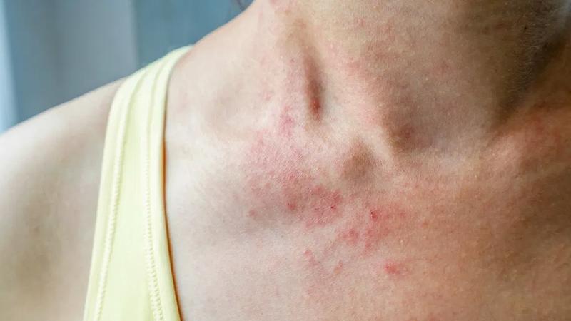 Dị ứng mạt bụi - Nguyên nhân gây ra viêm xoang, hen suyễn 1