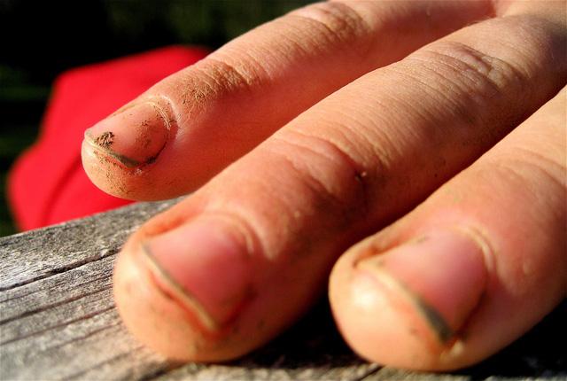 Nếu vi khuẩn phát triển dưới móng tay, nó sẽ trông như thế này