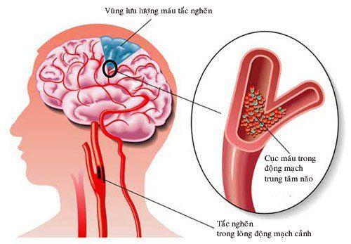 Thiếu máu não cục bộ làm chóng mặt trung ương
